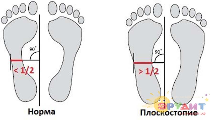 Фото как определить плоскостопие